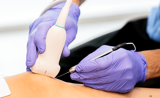 Radiofrequency Ablation